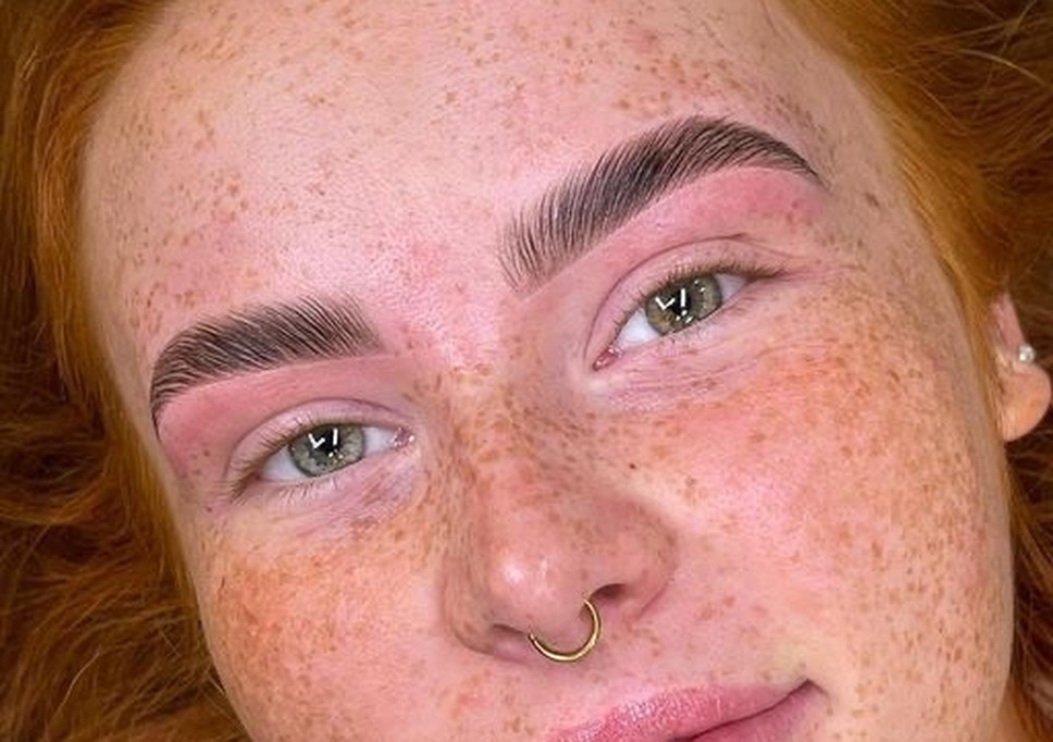 Brow Lift 4